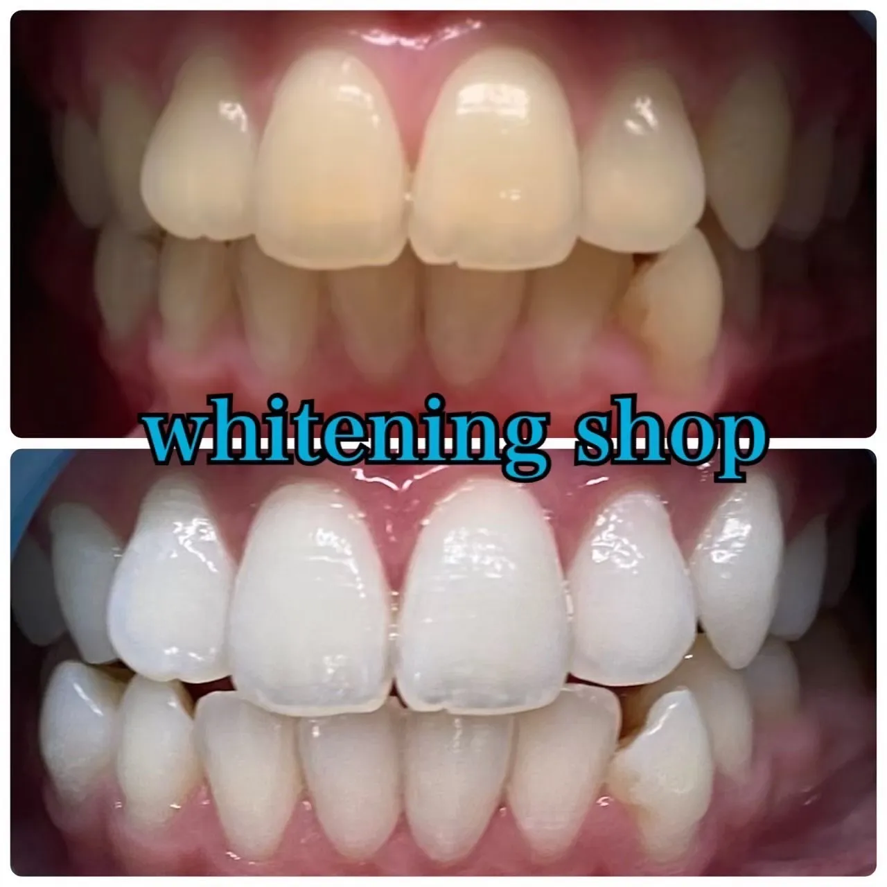 【セルフホワイトニングの嬉しいポイント♪】