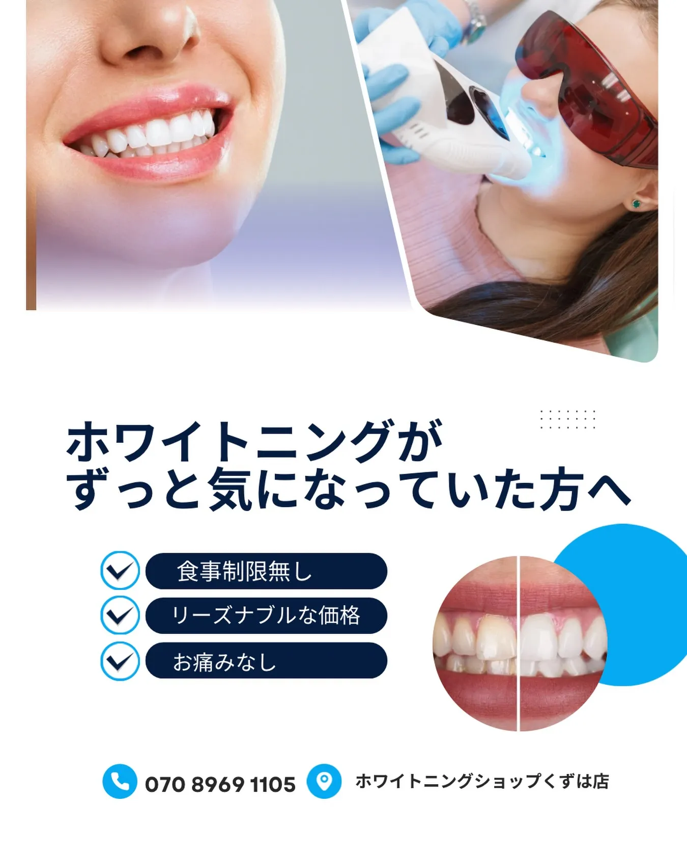 【ホワイトニングがずっと気になっていた方へ】